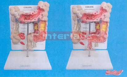 DESK TYPE, COMMON PATHOLOGIES OF COLON AND RECTUM MODEL WITH DESCRIPTION PLATE